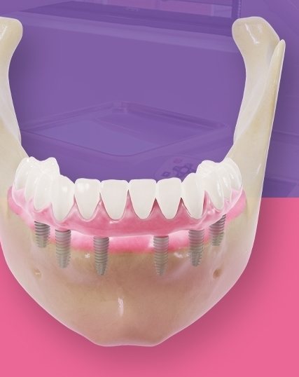 디지털 풀아치 배너 — 아래턱뼈 모형에 임플란트 6개로 고정한 전체 보철(분홍 잇몸·흰 치아)