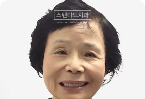 CASE 4 치료 후(AFTER) 사진