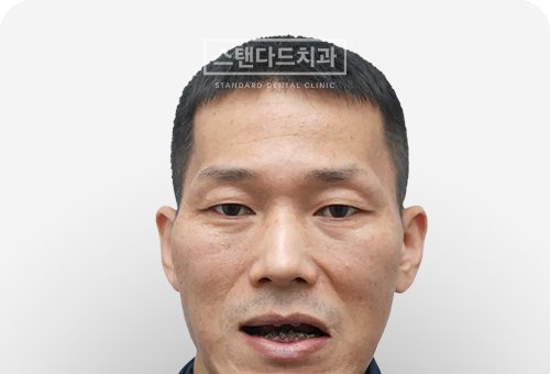 CASE 6 치료 전(BEFORE) 사진