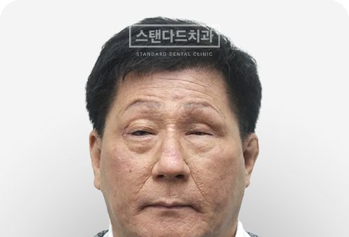 CASE 7 치료 전(BEFORE) 사진