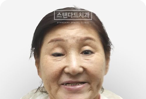 CASE 11 치료 전(BEFORE) 사진