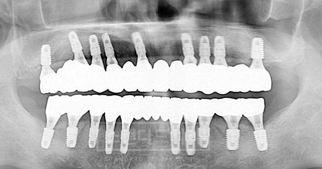 치료사례 1 치료 후 파노라마 X-ray(위아래 전체 임플란트 보철)