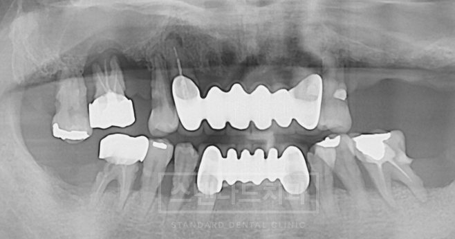 치료사례 1 치료 전 파노라마 X-ray(남은 치아·기존 보철, 스탠다드치과 워터마크)