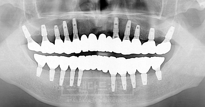 치료사례 2 치료 후 파노라마 X-ray(위아래 전체 임플란트 보철)