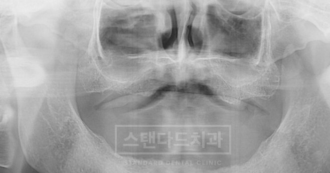 치료사례 2 치료 전 파노라마 X-ray(남은 치아·기존 보철, 스탠다드치과 워터마크)