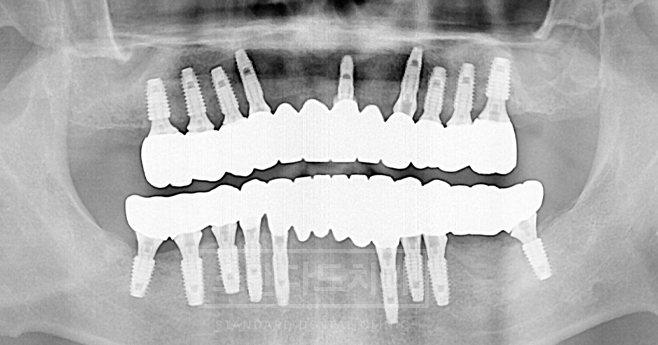 치료사례 3 치료 후 파노라마 X-ray(위아래 전체 임플란트 보철)