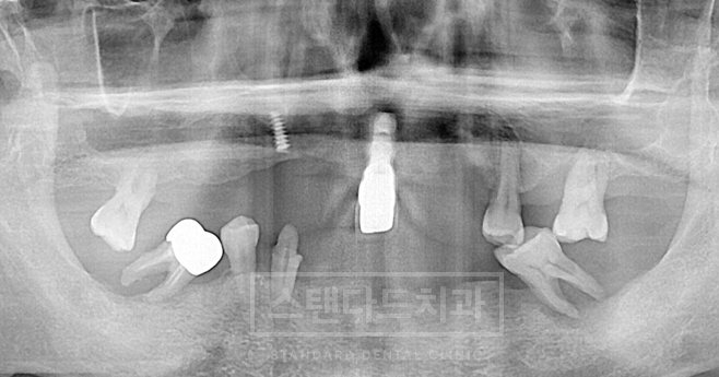 치료사례 3 치료 전 파노라마 X-ray(남은 치아·기존 보철, 스탠다드치과 워터마크)