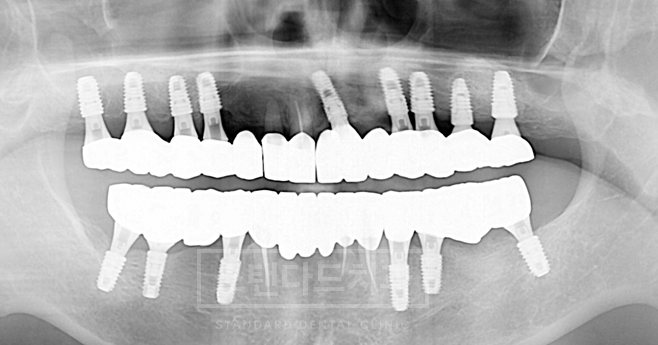 치료사례 4 치료 후 파노라마 X-ray(위아래 전체 임플란트 보철)