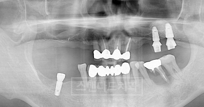치료사례 4 치료 전 파노라마 X-ray(남은 치아·기존 보철, 스탠다드치과 워터마크)
