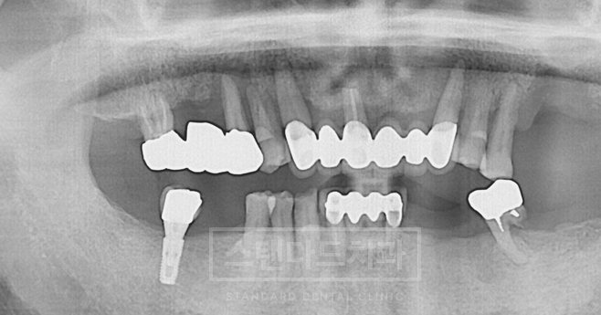 치료사례 5 치료 전 파노라마 X-ray(남은 치아·기존 보철, 스탠다드치과 워터마크)