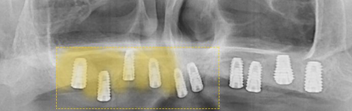 상악동 이식 후 파노라마 X-ray — 위턱에 임플란트 여러 개, 이식한 뼈 부분을 노란색 상자로 강조