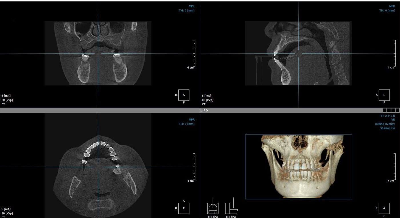 3D CT 진단 화면 4분할 — 관상면·시상면·축면 단층 사진과 두개골 3D 재구성