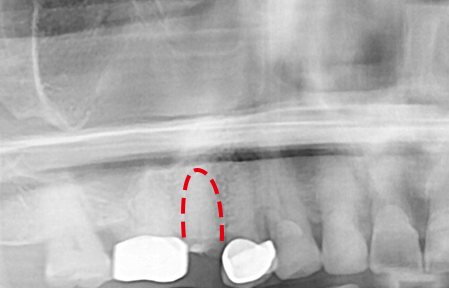 즉시식립 사례 X-ray 1 — 치료 전 X-ray — 치아뿌리만 남은 자리를 빨간 점선으로 표시