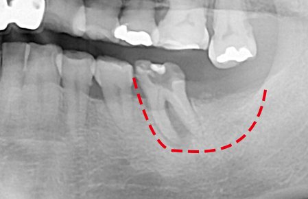 즉시식립 사례 X-ray 4 — 치료 전 X-ray — 치아뿌리와 주변 잇몸까지 퍼진 염증 범위를 빨간 점선으로 표시
