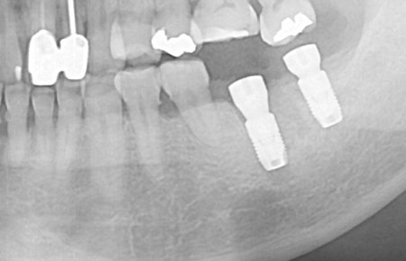 즉시식립 사례 X-ray 5 — 같은 날 발치·잇몸뼈 이식 후 임플란트 2개를 심은 X-ray