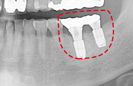 즉시식립 사례 X-ray 6 — 보철물을 끼운 뒤 X-ray — 임플란트 2개와 연결 보철을 빨간 점선으로 표시