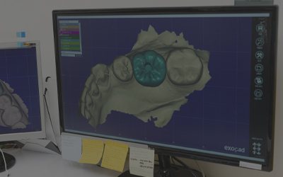 자체기공실 — 모니터의 치아 보철 CAD 설계 화면(exocad)