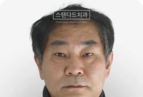 CASE 1 — 치료 전 정면 얼굴 사진(BEFORE)
