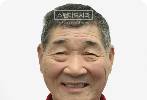 CASE 2 — 치료 후 정면 얼굴 사진(AFTER, 웃는 얼굴)