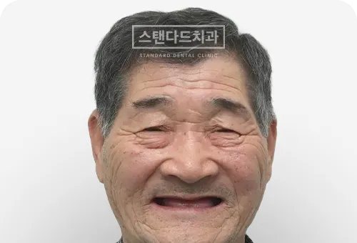 CASE 2 — 치료 전 정면 얼굴 사진(BEFORE)
