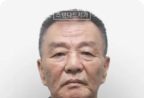 CASE 3 — 치료 전 정면 얼굴 사진(BEFORE)