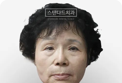 CASE 4 — 치료 전 정면 얼굴 사진(BEFORE)