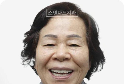 CASE 5 — 치료 후 정면 얼굴 사진(AFTER, 웃는 얼굴)