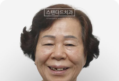 CASE 5 — 치료 전 정면 얼굴 사진(BEFORE)