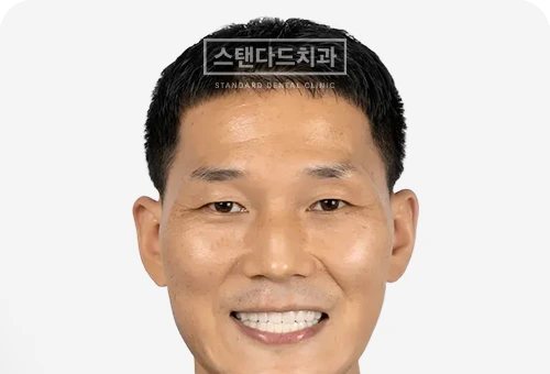 CASE 6 — 치료 후 정면 얼굴 사진(AFTER, 웃는 얼굴)