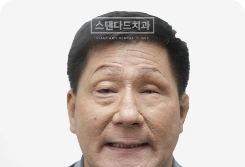 CASE 7 — 치료 후 정면 얼굴 사진(AFTER, 웃는 얼굴)