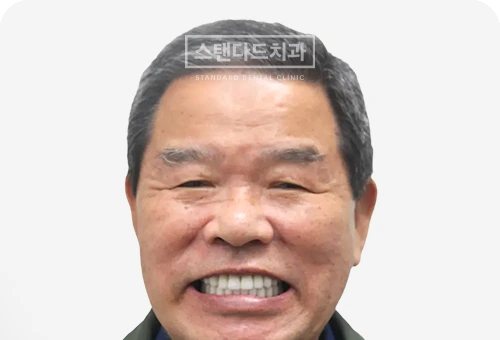 CASE 9 — 치료 후 정면 얼굴 사진(AFTER, 웃는 얼굴)