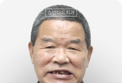 CASE 9 — 치료 전 정면 얼굴 사진(BEFORE)