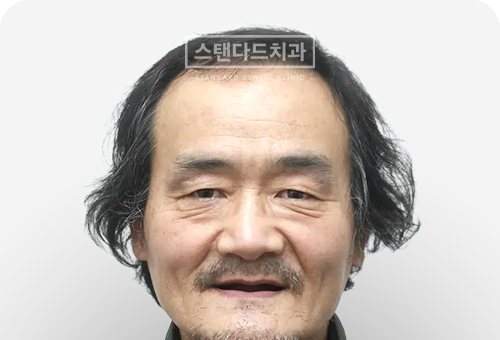 CASE 11 — 치료 전 정면 얼굴 사진(BEFORE)