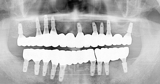 치료사례 5 치료 후 파노라마 X-ray(위아래 전체 임플란트 보철)
