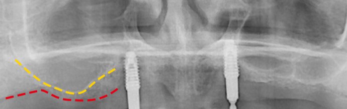 상악동 이식 전 파노라마 X-ray — 위턱 양쪽 임플란트 2개, 얇은 잇몸뼈를 노랑·빨강 점선으로 표시