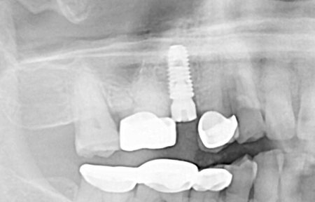 즉시식립 사례 X-ray 2 — 같은 날 발치·잇몸뼈 이식 후 임플란트를 심은 X-ray