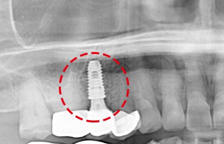 즉시식립 사례 X-ray 3 — 보철물을 끼운 뒤 X-ray — 임플란트를 빨간 점선 원으로 표시