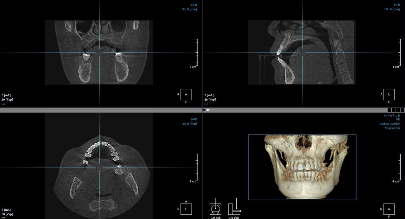 3D CT 진단 화면 4분할 — 관상면·시상면·축면 단층 사진과 두개골 3D 재구성